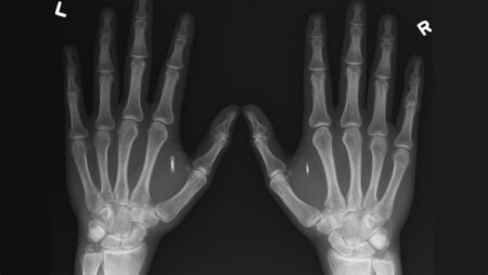 The biohacking scene is gearing up for next-gen implants