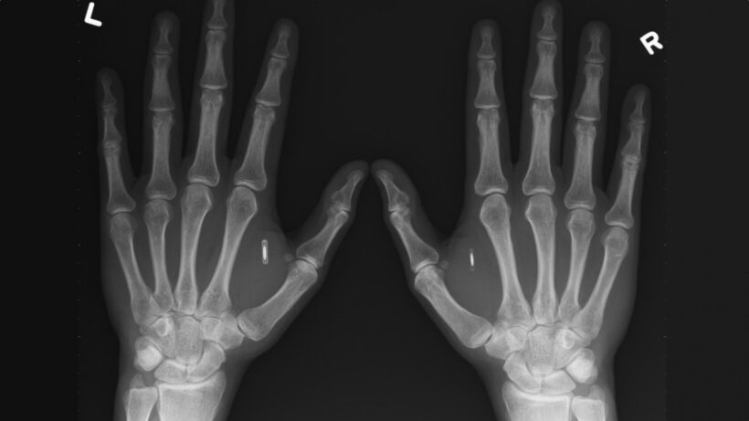 US presidential candidate gets RFID/NFC chip implanted in his hand